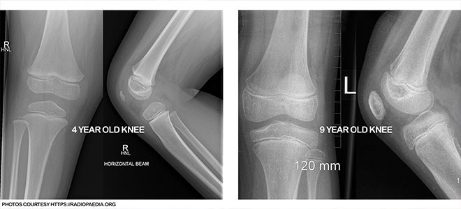 x-ray of a active child's knee